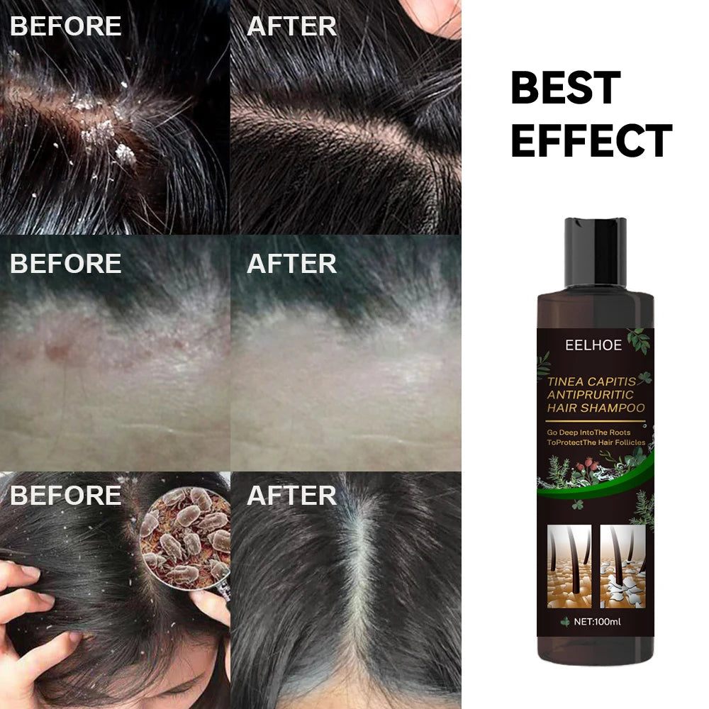 EELHOE champú de Limpieza del cabello anticaspa eliminar ácaros aliviar la picazón Control de aceite limpieza del cuero cabelludo champú refrescante para el cabello