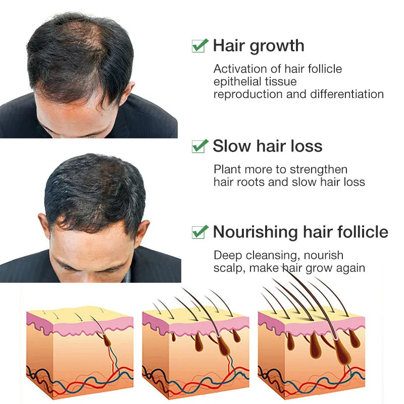 Suero para el Crecimiento del Cabello, Aceite Anticaída y Regenerador, Previene la Calvicie, Repara el Daño, Masajea el Cuero Cabelludo, Hidrata y Nutre, Cuidado Capilar