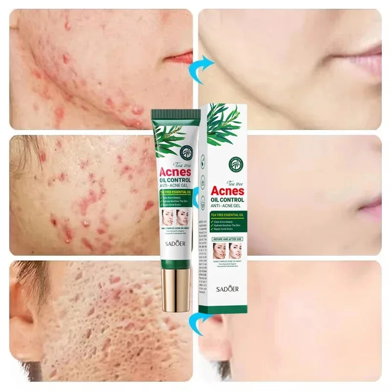 Crema para eliminar el acné del árbol de té, Control de aceite hidratante suave para el rostro, Gel Facial para eliminar el acné, espinillas, belleza y salud