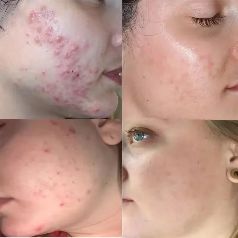 Crema para eliminar el acné del árbol de té, Control de aceite hidratante suave para el rostro, Gel Facial para eliminar el acné, espinillas, belleza y salud