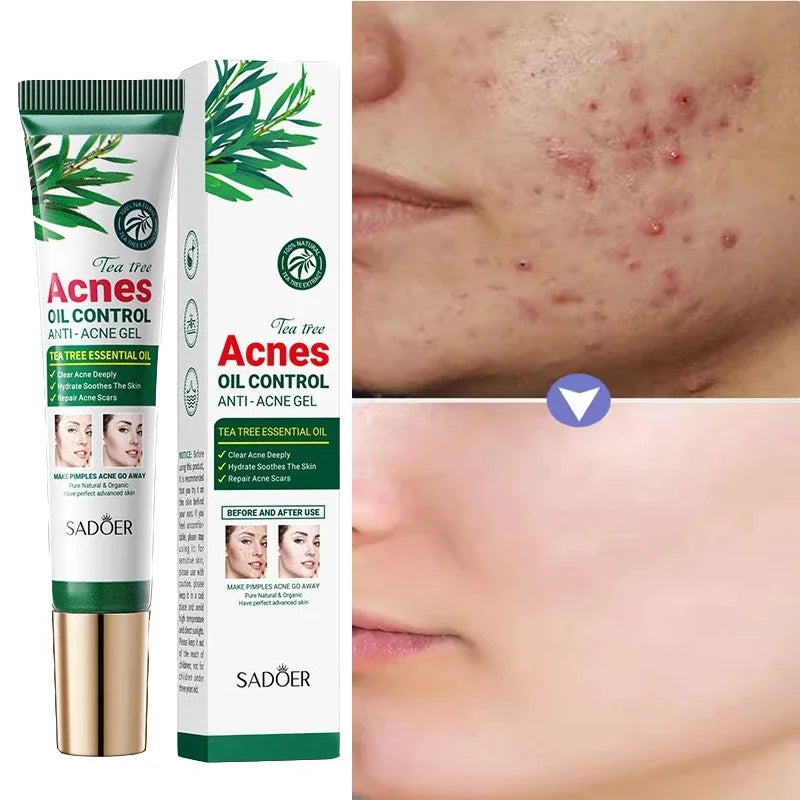 Crema para eliminar el acné del árbol de té, Control de aceite hidratante suave para el rostro, Gel Facial para eliminar el acné, espinillas, belleza y salud