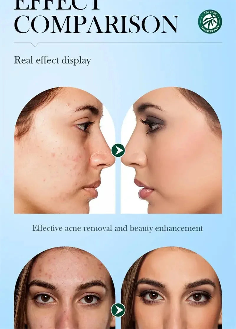 Crema para eliminar el acné del árbol de té, Control de aceite hidratante suave para el rostro, Gel Facial para eliminar el acné, espinillas, belleza y salud