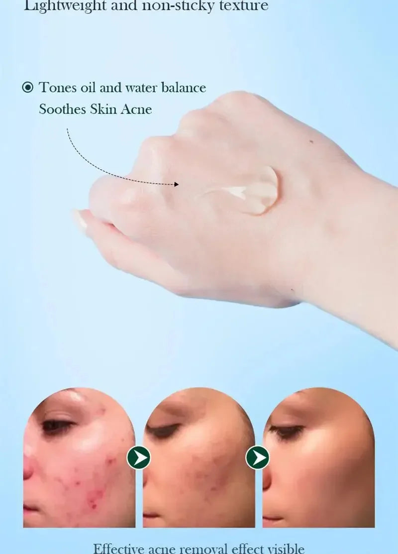 Crema para eliminar el acné del árbol de té, Control de aceite hidratante suave para el rostro, Gel Facial para eliminar el acné, espinillas, belleza y salud