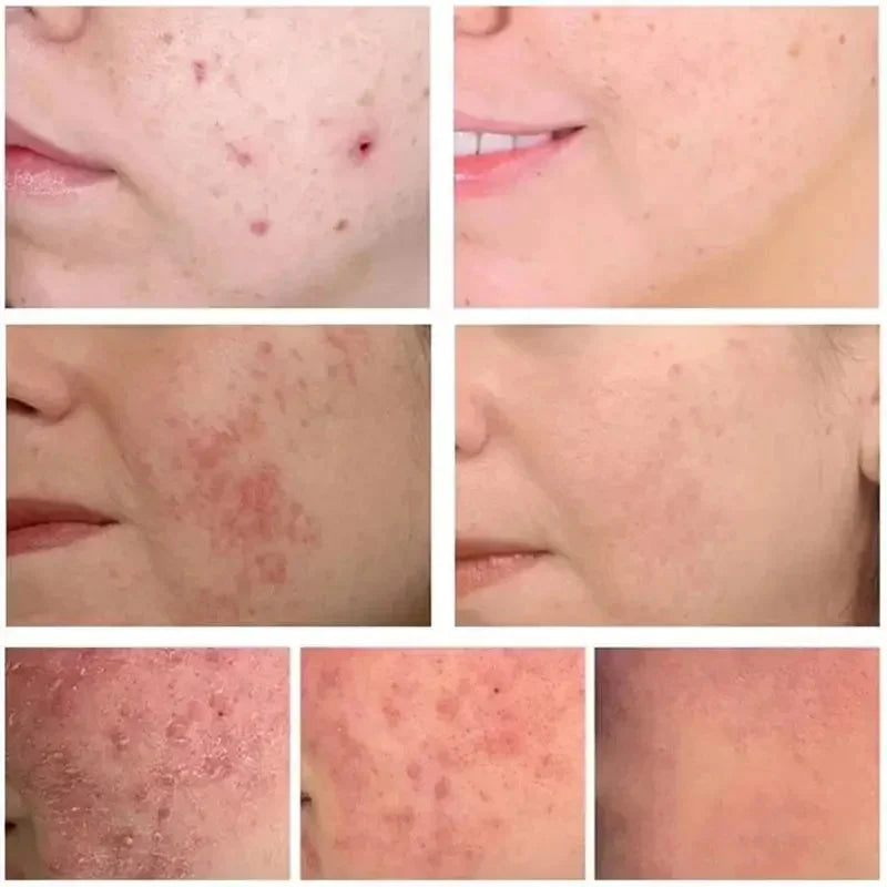 Crema para eliminar el acné del árbol de té, Control de aceite hidratante suave para el rostro, Gel Facial para eliminar el acné, espinillas, belleza y salud